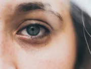 Saiba quais são os tipos de olheiras e como combatê-las